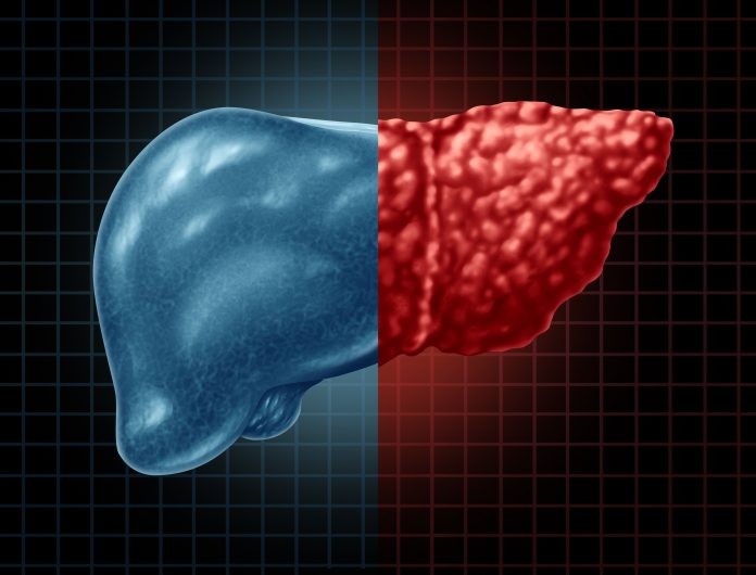 Obesity-driven Fatty Liver Disease Predicts Your Healthspan